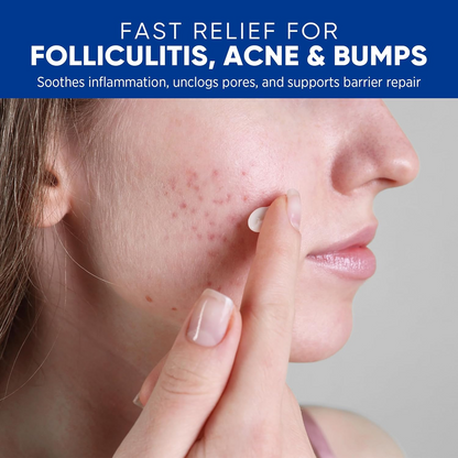 Folliculitis & Acne Treatment Cream – Salicylic Acid & Herbal Extracts for Scalp