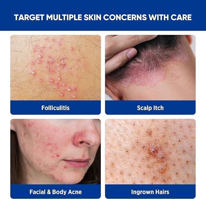 Folliculitis & Acne Treatment Cream – Salicylic Acid & Herbal Extracts for Scalp