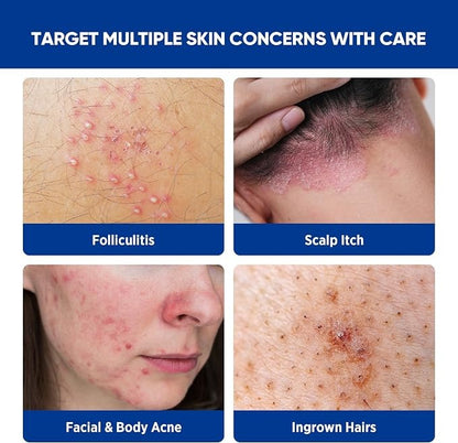 Folliculitis & Acne Treatment Cream – Salicylic Acid & Herbal Extracts for Scalp